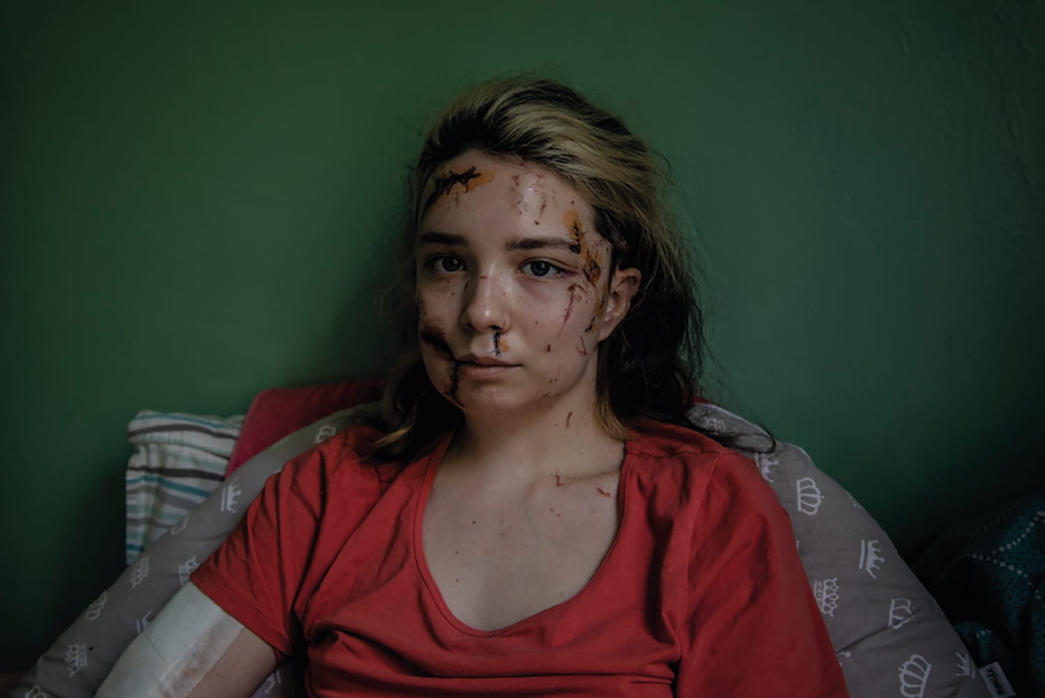 Bilde som viser kvinne med skader i ansiktet etter krig.